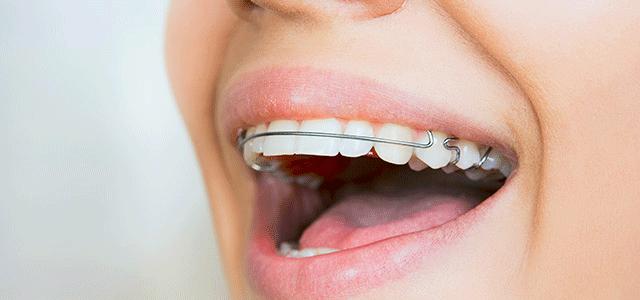 Как быстро выровнять зубы без брекетов?
