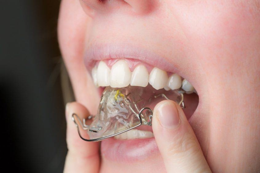 Как выровнять кривой зуб без брекетов?