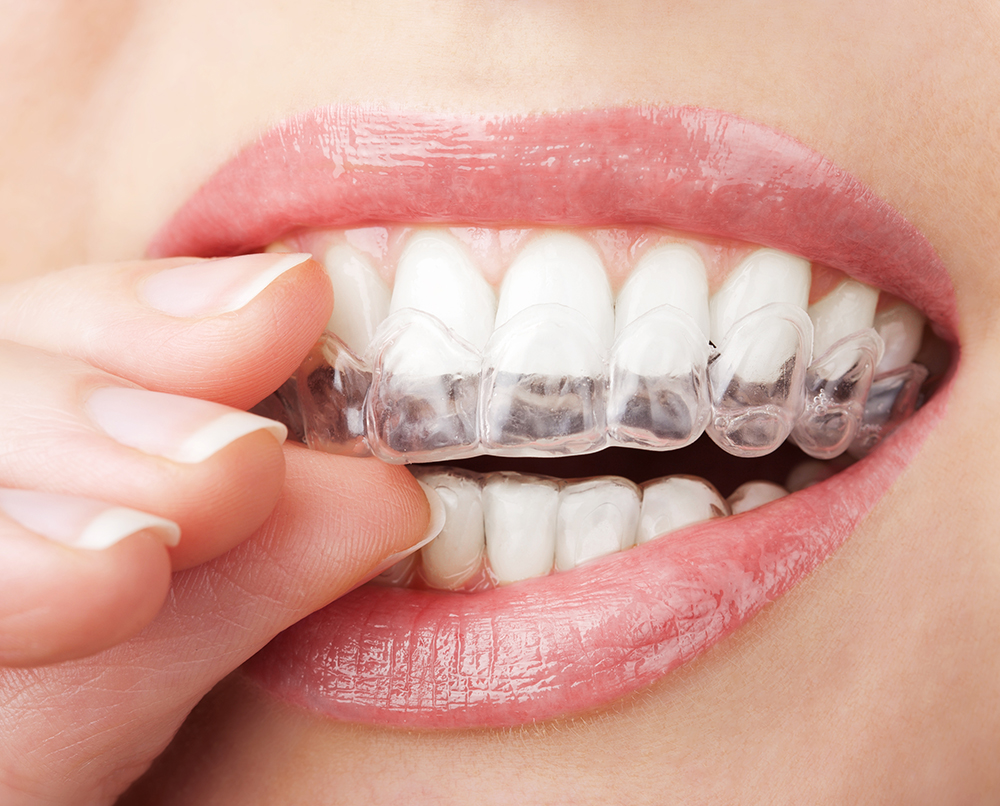 Как выровнять зубы без брекетов?