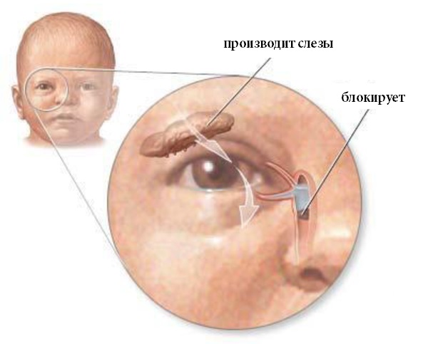 дакриоцистит у новорожденных