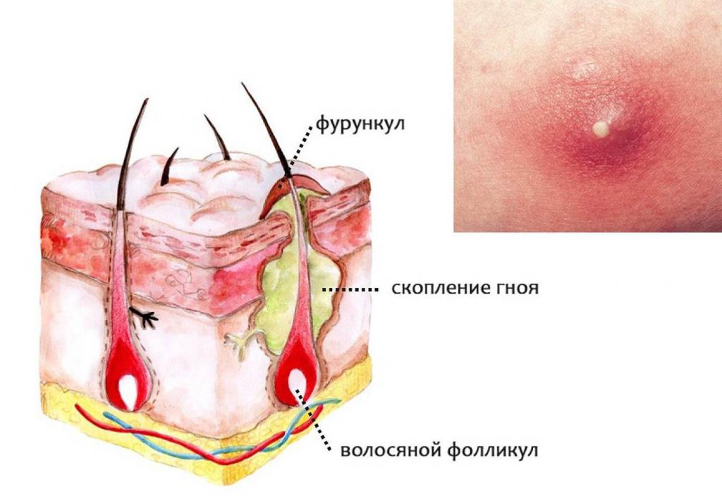 стадии развития фурункула