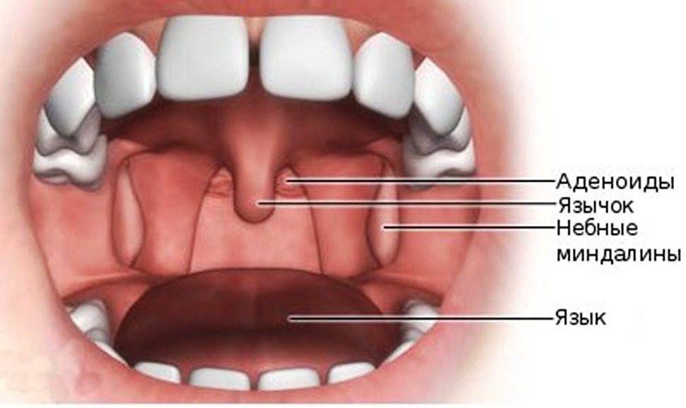 аденоиды и гланды