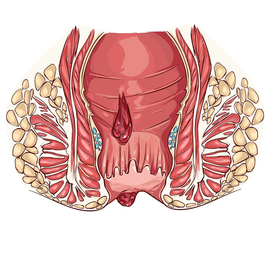 геморроидальные шишки