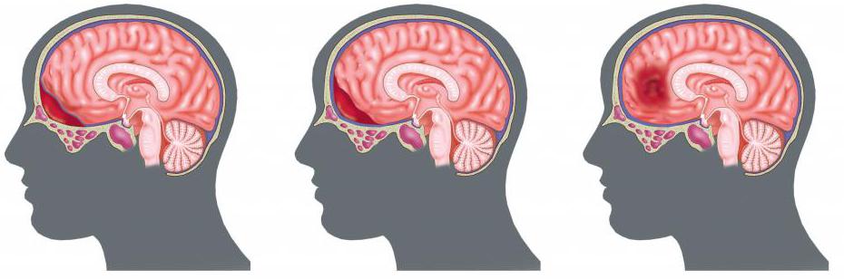 гематома головного мозга