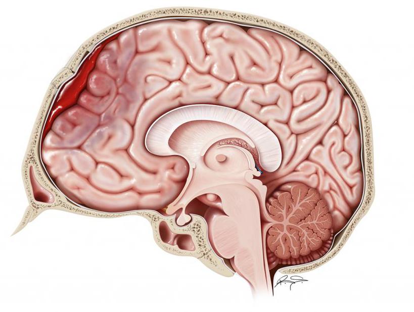 гематома головного мозга лечение