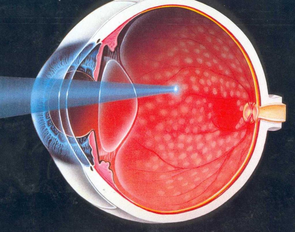 Лазерная коагуляция сетчатки глаза