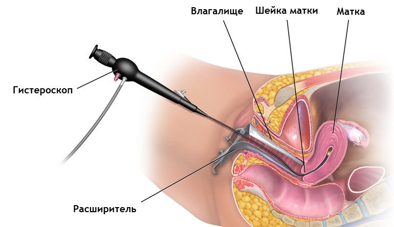 процедура выскабливания