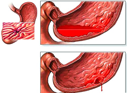язвы желудка