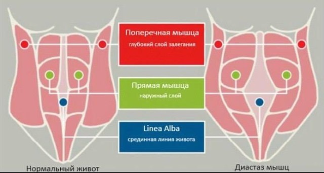 диастаз мышц живота у мужчин