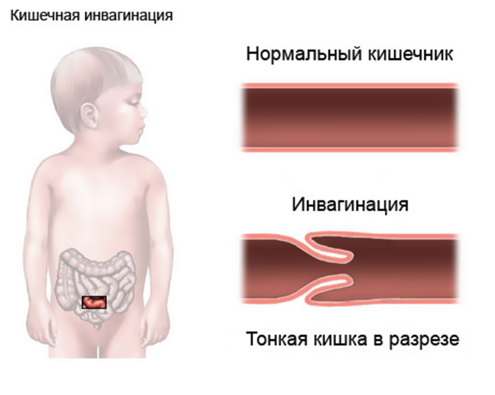 Инвагинация кишечника