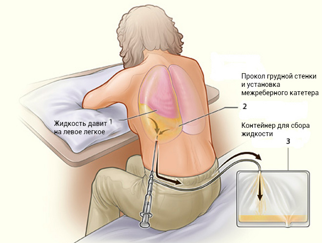 двухсторонний гидроторакс легких