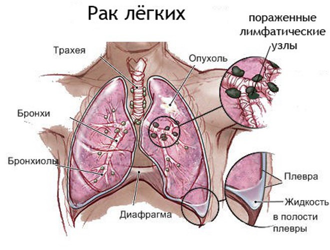 Рак легких