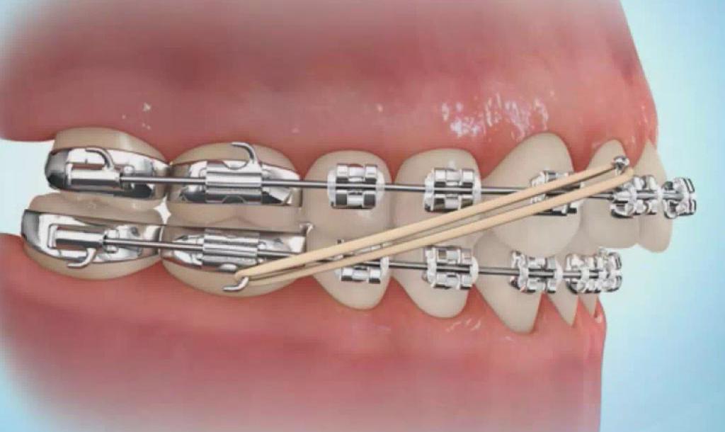 ортодонтические эластичные тяги