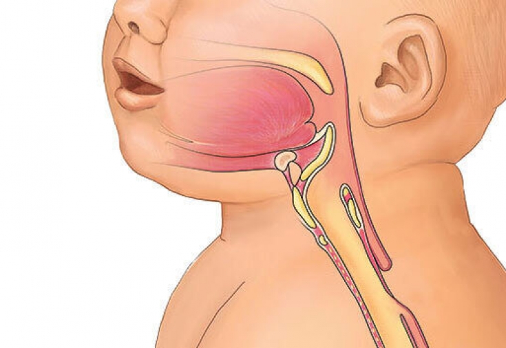 Атрезия пищевода у новорожденных