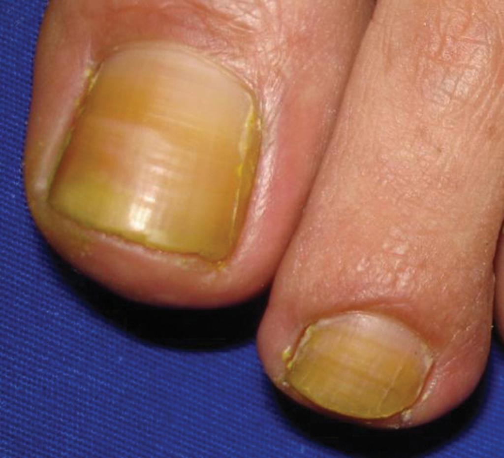 желтые ногти на стопах