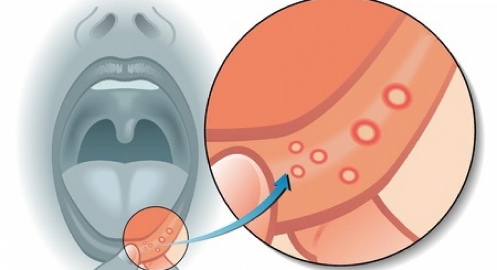 язвочки во рту