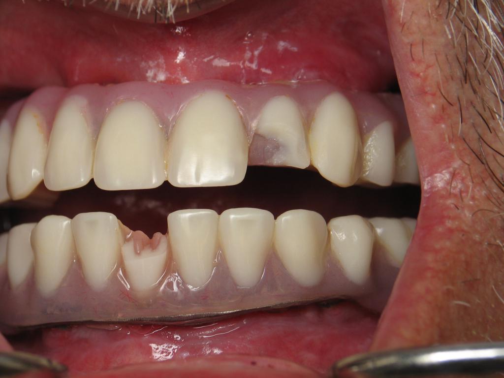 Травмы зуба