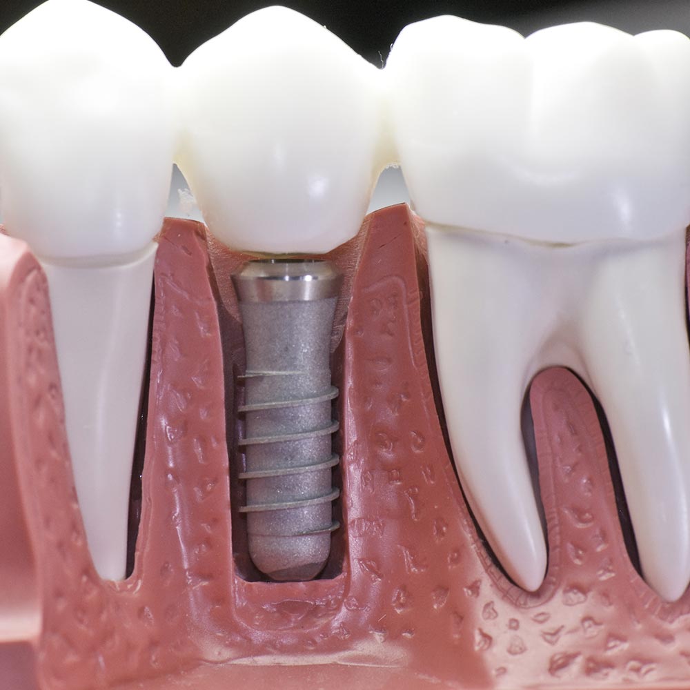 Современные методы восстановления зубов