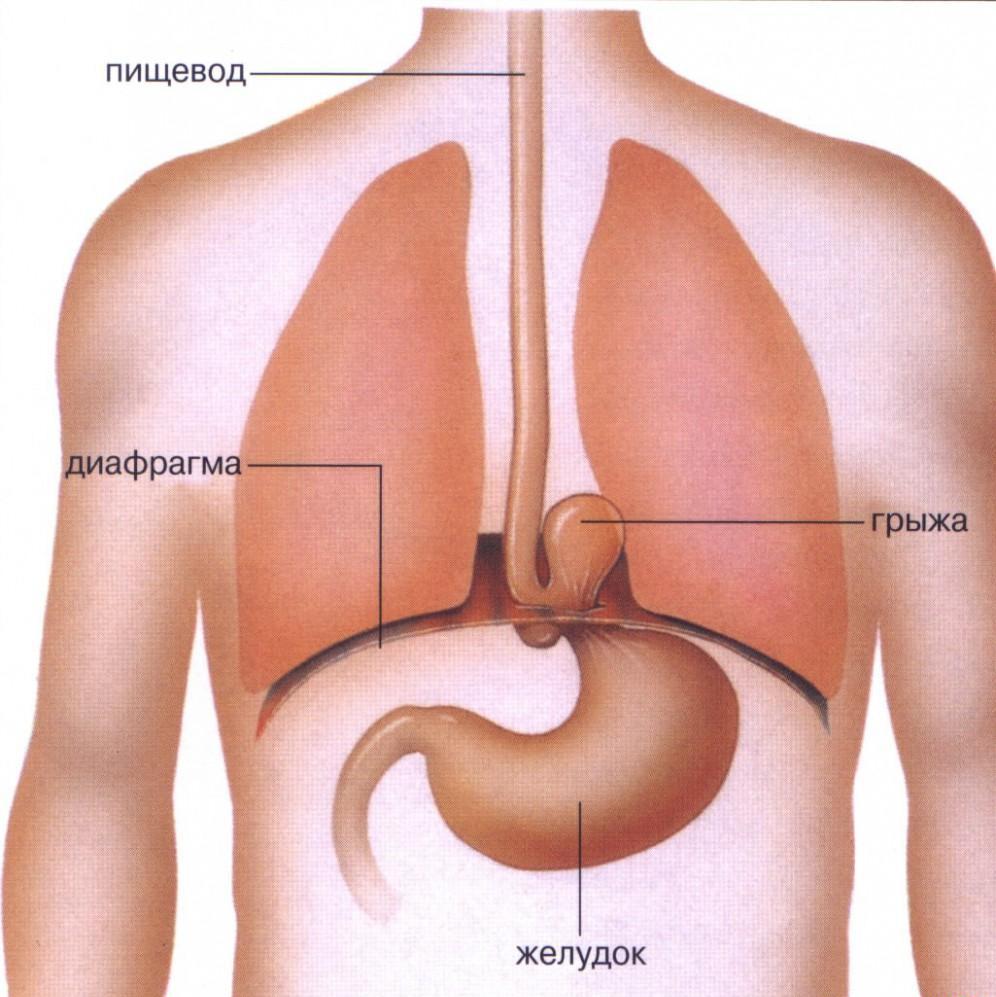 грыжа желудка