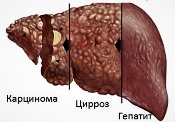 Иллюстрация заболеваний печени