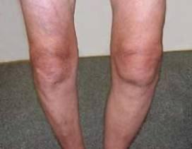 Жидкость в коленном суставе: лечение, симптомы, профилактика