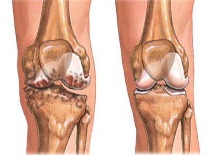 субхондральный склероз суставных поверхностей
