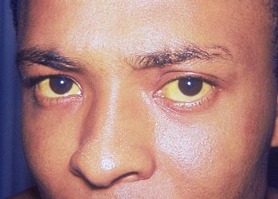 желтые глазные белки 