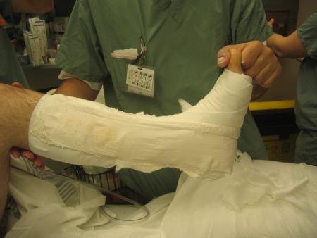 Симптомы и лечение трещин в костях рук ног