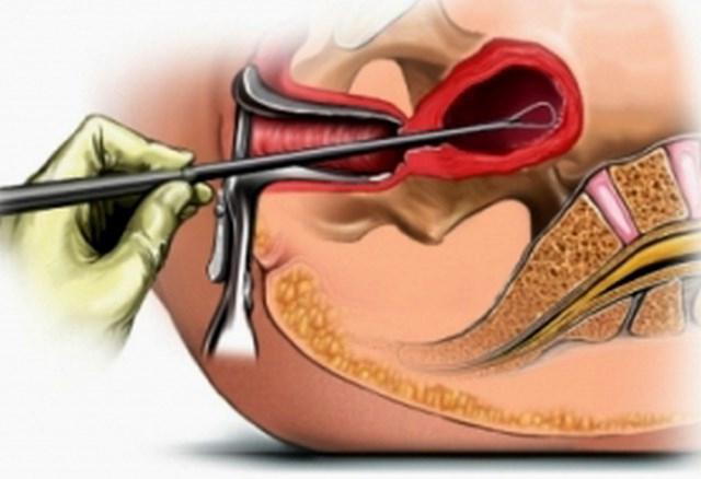 месячные после выскабливания