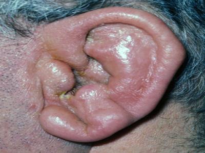 Болит ушная раковина