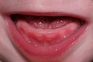 режутся зубы у ребенка симптомы