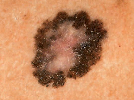 Как проявляется рак кожи