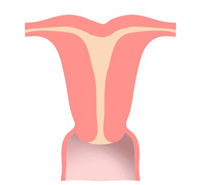 гипоплазия матки