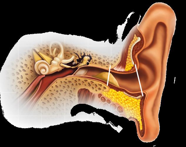 Пробка в ухе