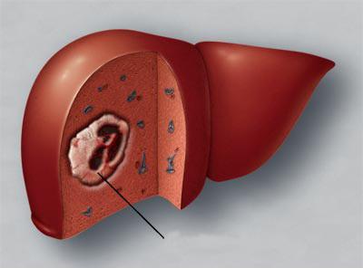 рак печени