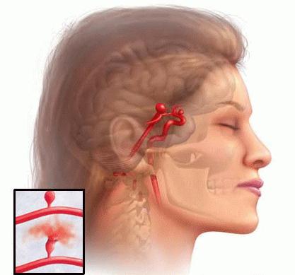 аневризма сосудов головного мозга лечение
