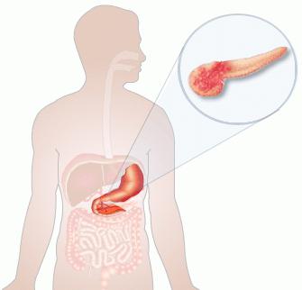 рак головки поджелудочной железы