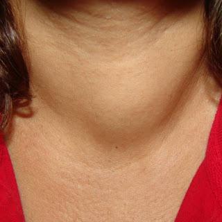 Рак щитовидной железы признаки