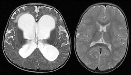 Заместительная гидроцефалия