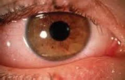 ангиопатия сетчатки обоих глаз