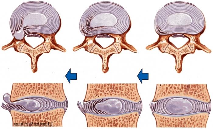 позвоночная грыжа