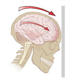 сотрясение мозга первая помощь