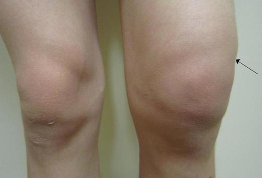 гемартроз коленного сустава 
