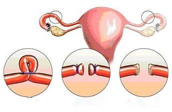 женская стерилизация последствия