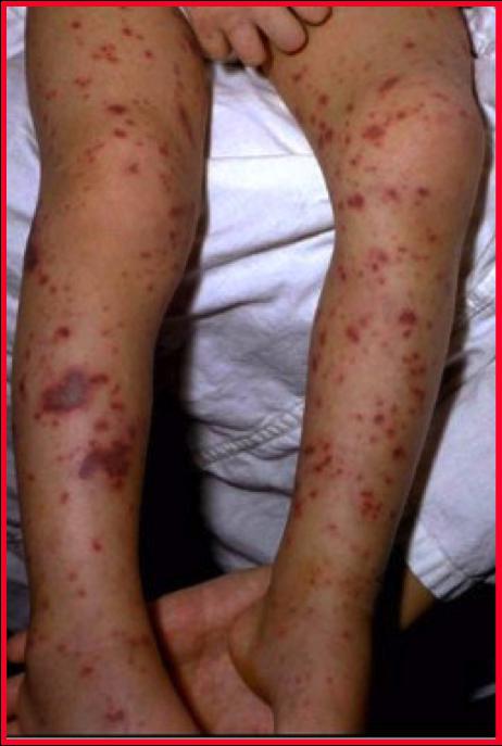 Менингококковая инфекция у детей симптомы
