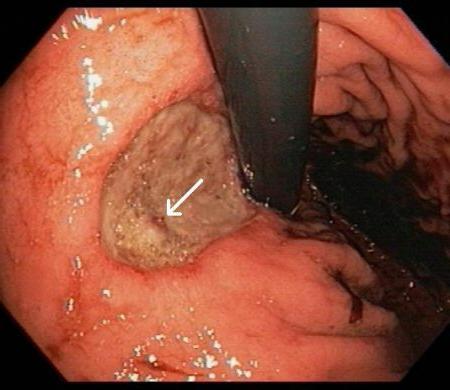 язва двенадцатиперстной кишки причины