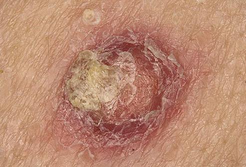 переход папилломы в рак кожи