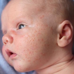 аллергия на лице у ребенка
