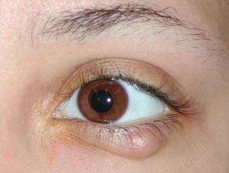 лечение глаза
