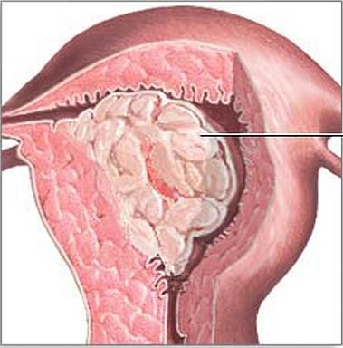 железистая гиперплазия эндометрия 